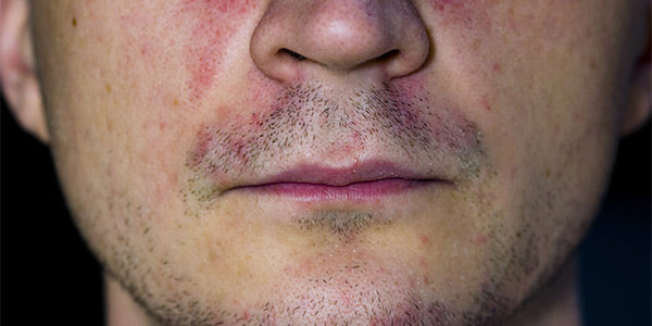 What Causes Rosacea?