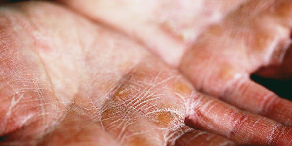 Will Skincare Help with Eczema?